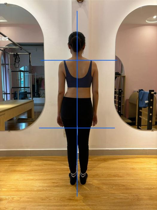 Đánh giá tư thế cong vẹo cột sống